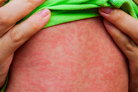 Brasil soma 37 casos de sarampo neste ano e reforça vacinação em meio à alta no continente